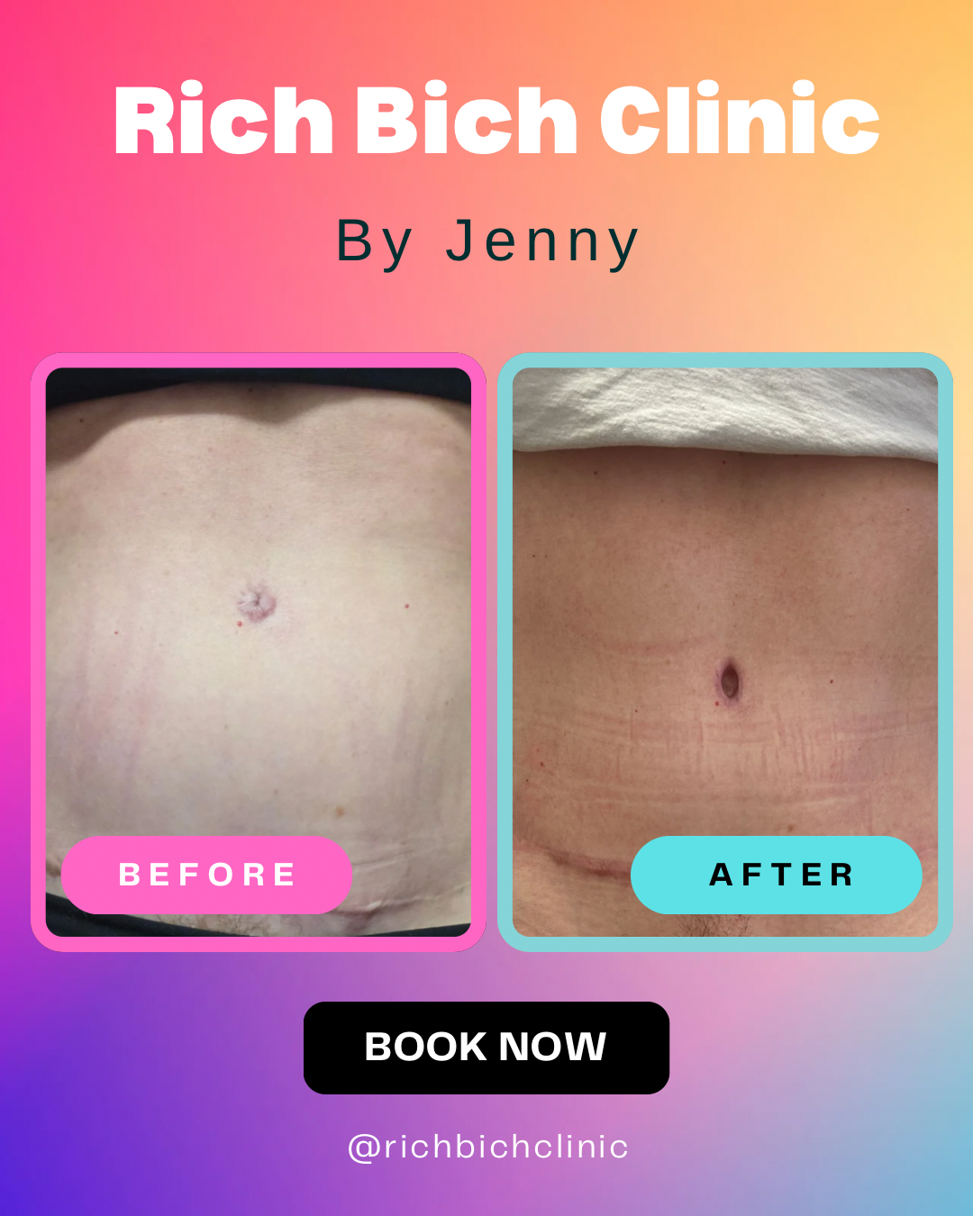 Belly Button Fix