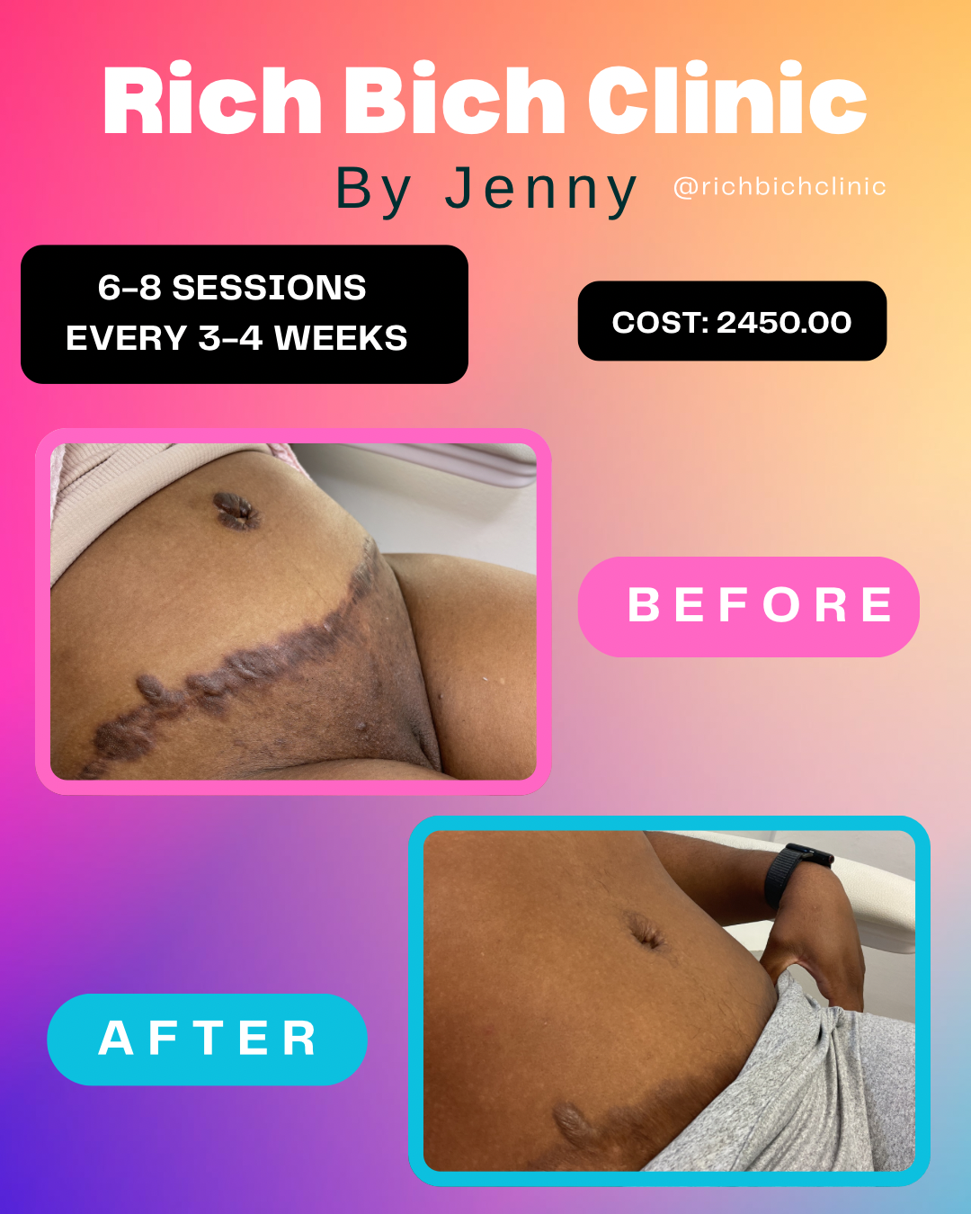 Belly Button Fix
