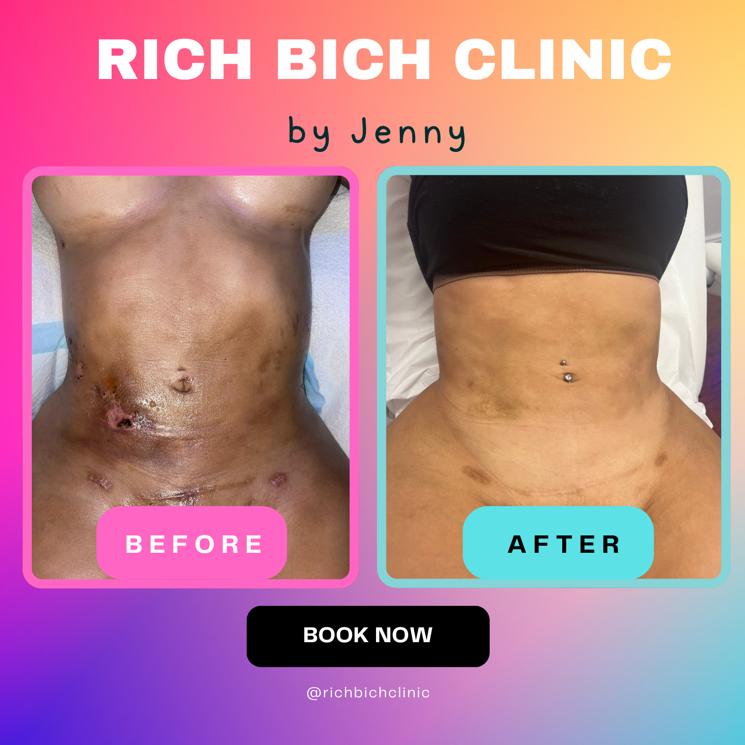 Custom Lipo Burn Package