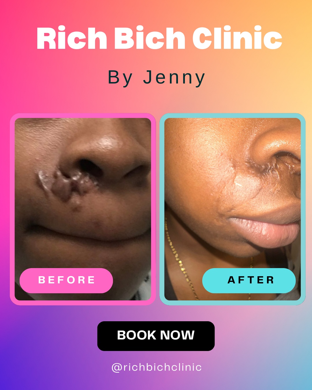 Custom Keloid Package