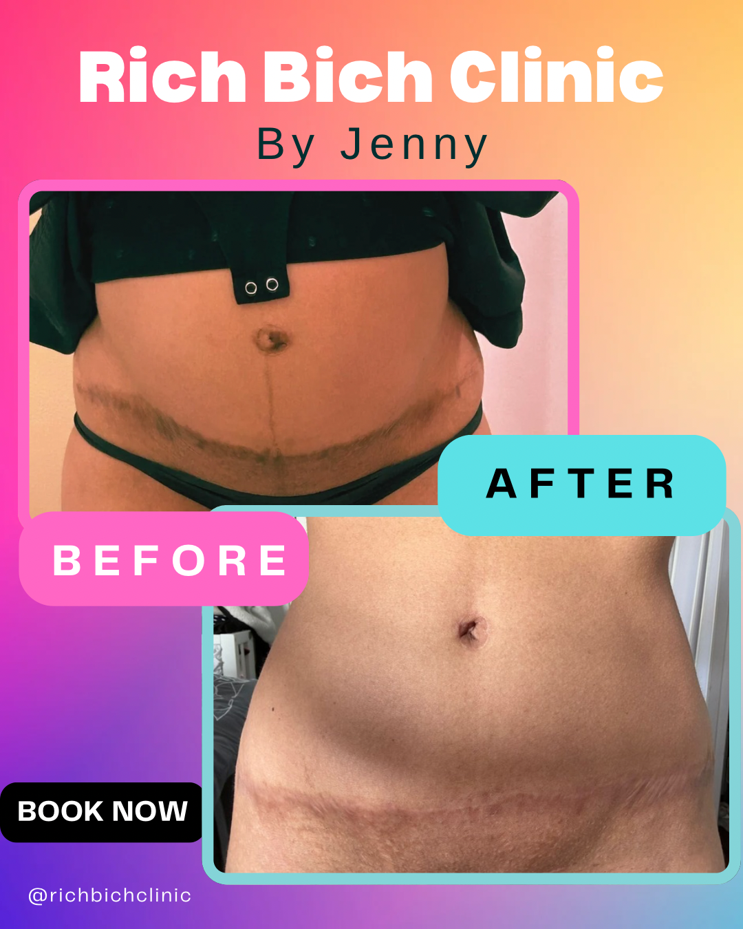 Tummy Tuck Scar Fix